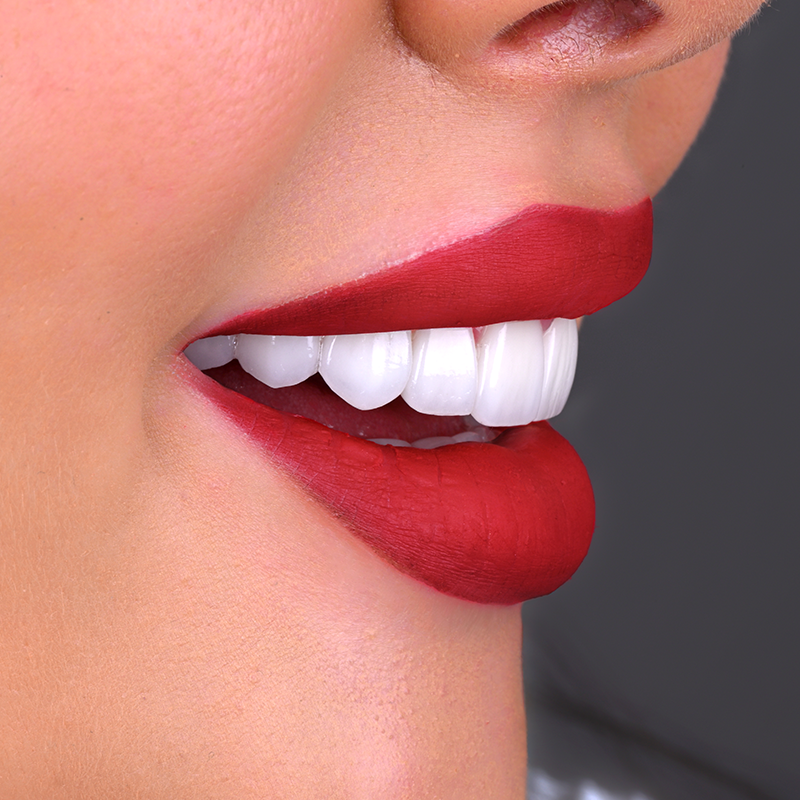 dental-veneers-smile