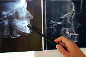 What's Orthognathic Surgical procedure? When Is It Mandatory? 3 img headxray