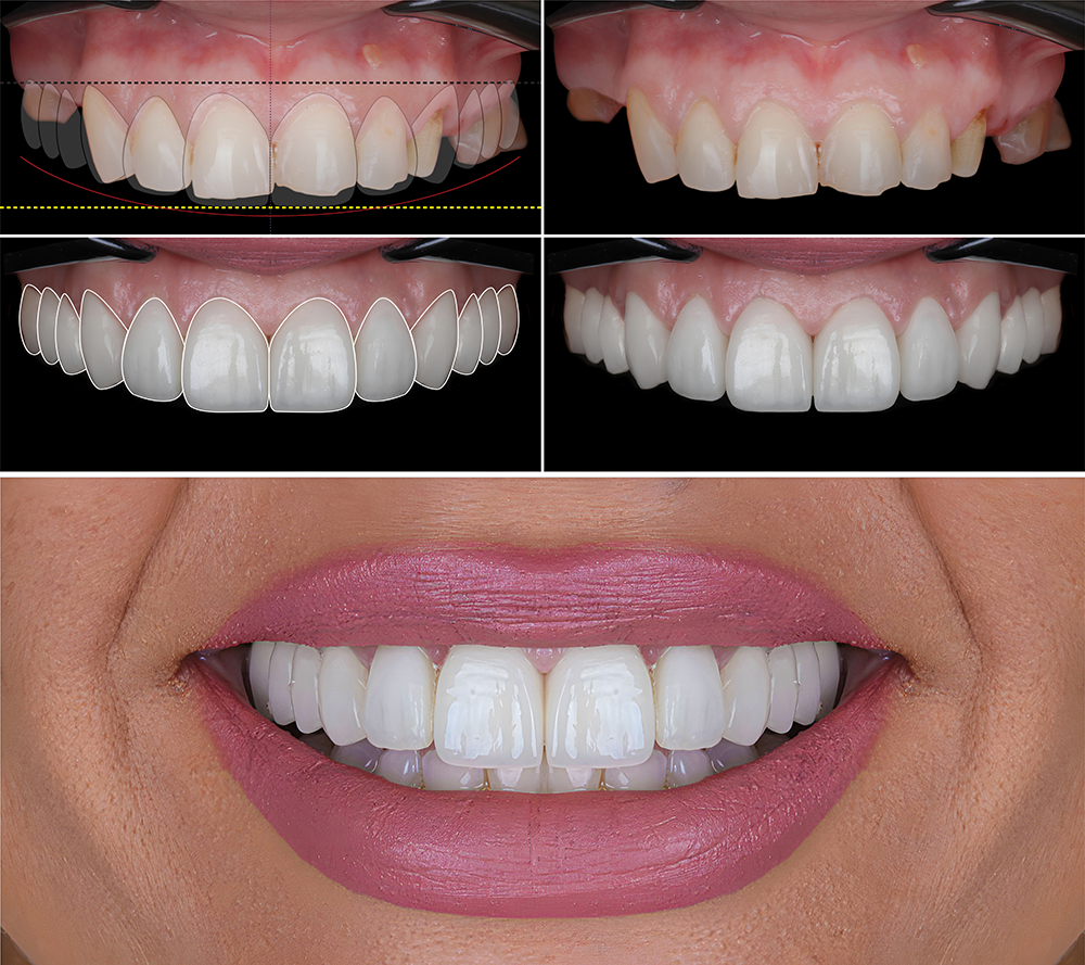 How Digital Dentistry is Making Dental Therapy Higher? 2 img 3d smile design